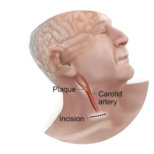 Transcarotid Artery Revascularization (TCAR) Treatment in Virginia