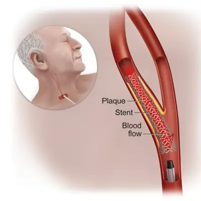 Advantages of TCAR Surgery