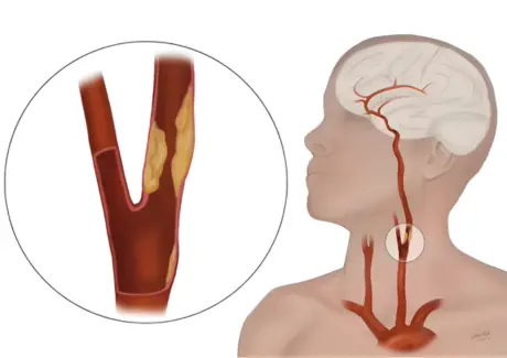 Transcarotid Artery Revascularization