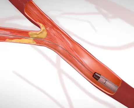 Who Needs Transcarotid Artery Revascularization Treatment