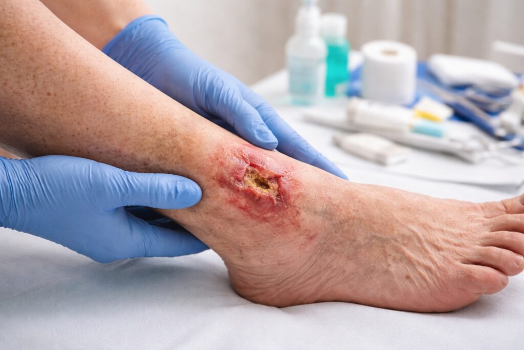 Close-up of an elderly person's leg showing a red, inflamed ulcer near the ankle, with a healthcare worker in blue gloves examining the wound. Medical supplies like gauze, antiseptic, and scissors are visible in the background.
