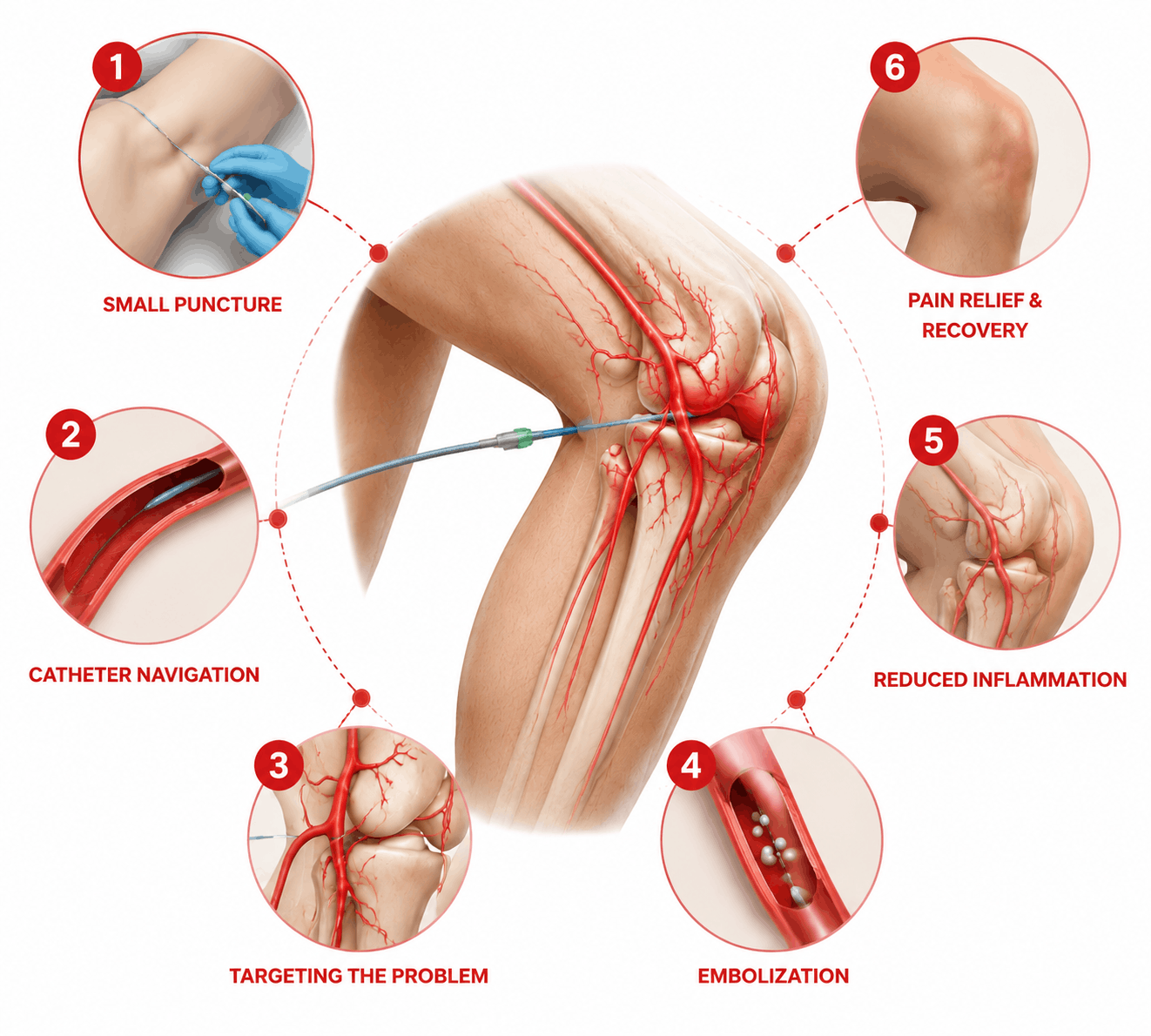How We Treat Knee Pain with GAE