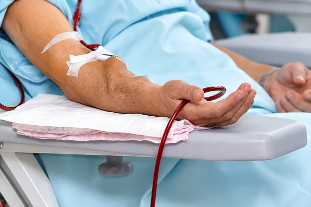 dialysis access steal syndrome, including AV fistula complications